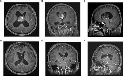 Effect comparison of neuroendoscopy versus microsurgery in the treatment of lateral ventricular tumors